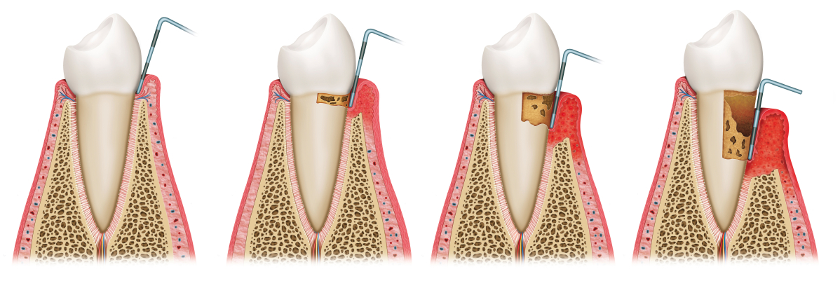 Stadien der Zahnfleischerkrankung
