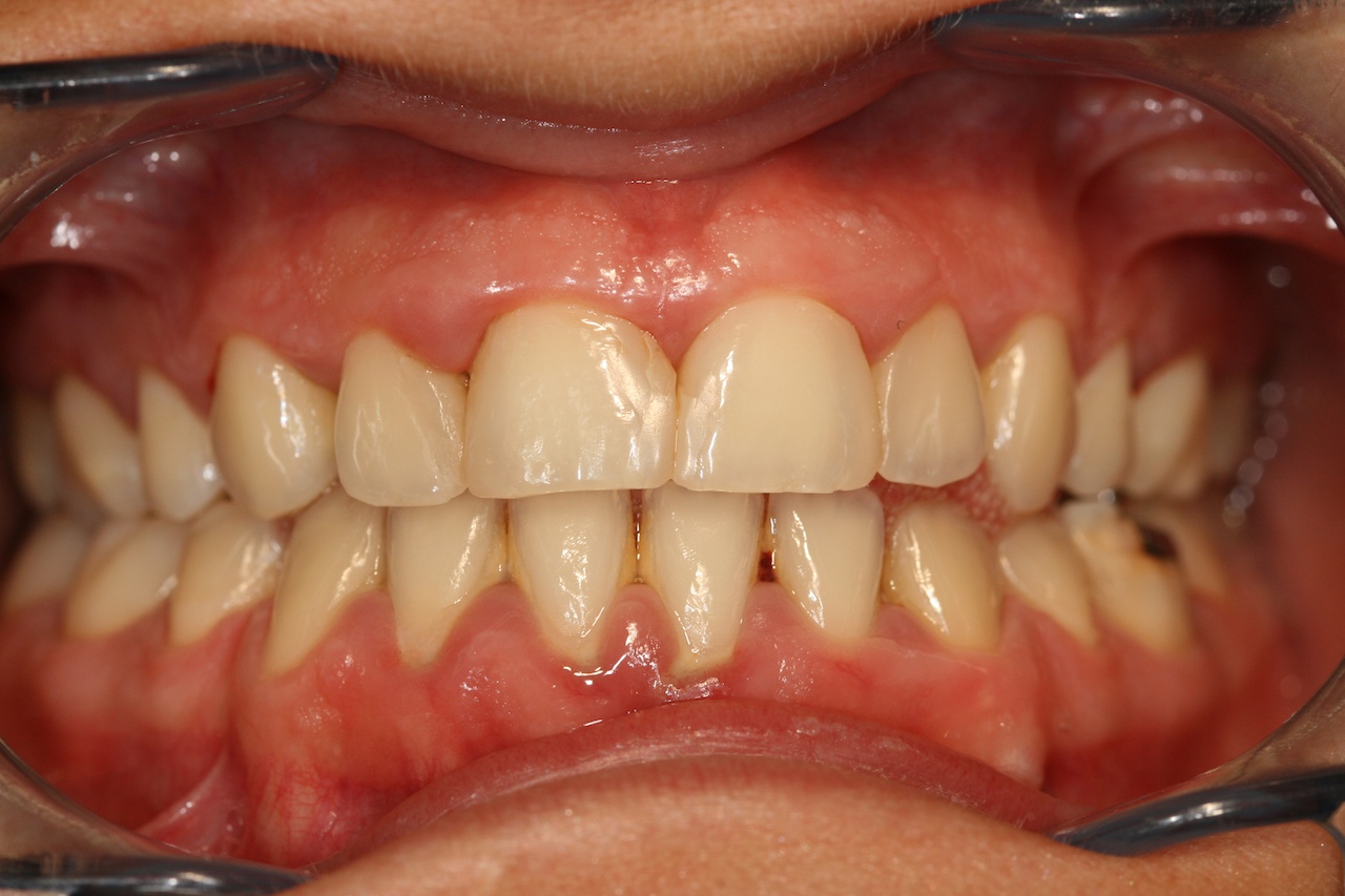 Chronische Parodontitis:entzündete Zahnfleischpapillen manchmal einziger Hinweis