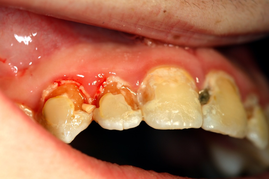 Ausgedehnte Zahnhalskaries durch persisitierende Plaque