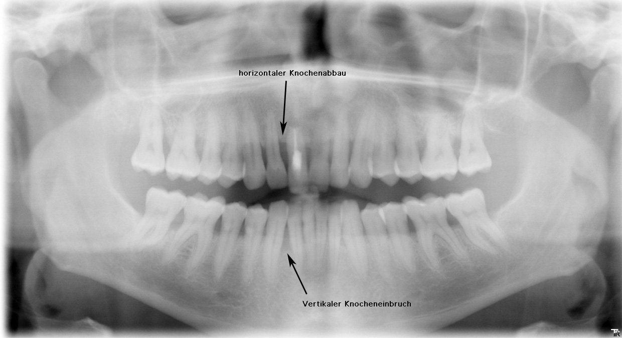 Chronische Parodontitis (mittelschwer) im Panoramaschichtröntgenbild