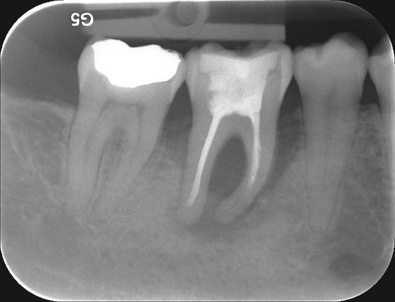 Paro-Endo-Läsion mit vollständiger Zerstörung des Zahnbetts